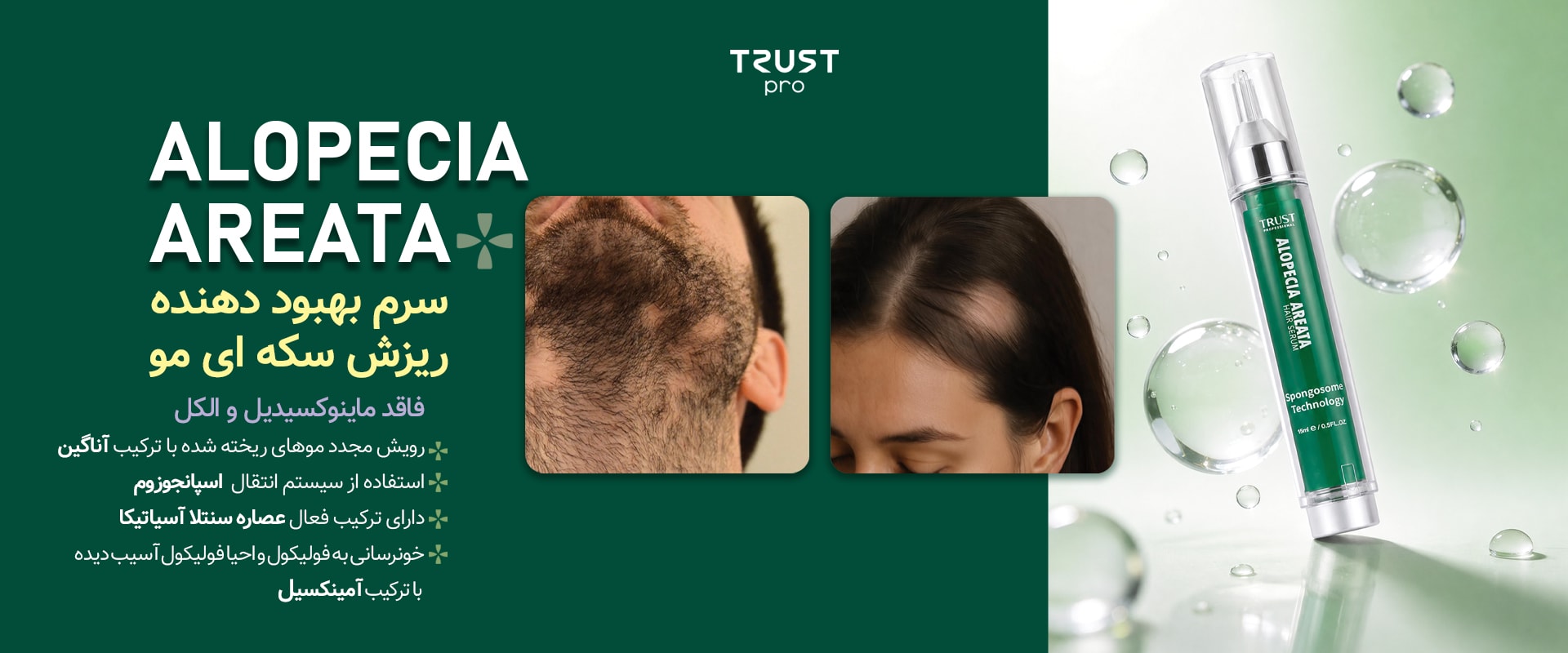 ALOPECIA